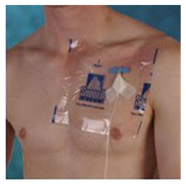 Wynn Shield/Active Ice Dressing Wound Shower Shield PU Flm 9x9" Adh Absorbent LF 98/Ca