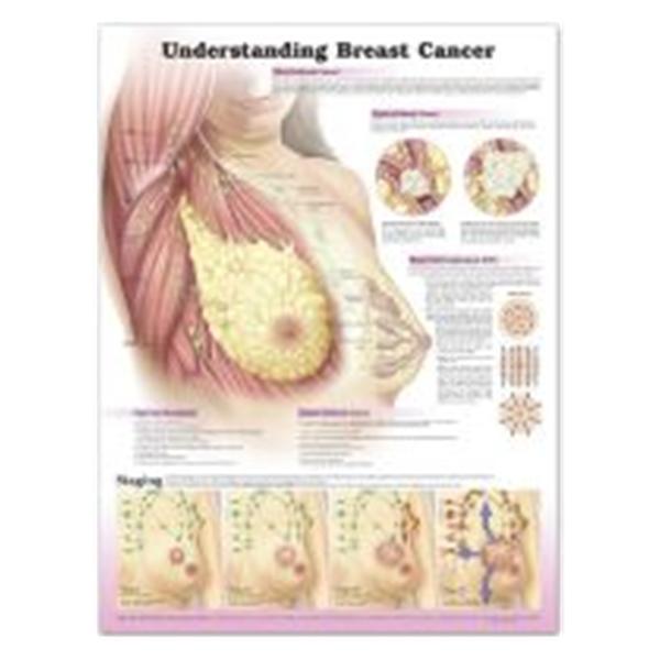 Wolters Kluwer Health  Chart Educational Understanding Breast Cancer Spanish 20x26" Ea