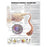 Wolters Kluwer Health  Chart Educational Understanding Diabetes 20x26" Ea