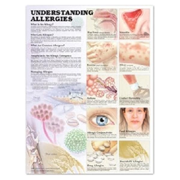 Wolters Kluwer Health  Chart Educational Understanding Allergies 20x26" Ea (9781587799402)