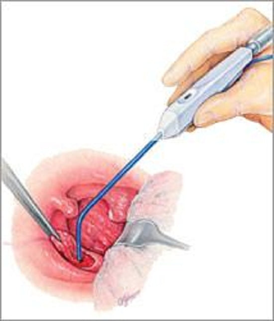 A&E Medical Suction Coagulator Cannula Tubing - Suction Coagulator Cannula Tubing, 10 Fr, 8" - 050-010