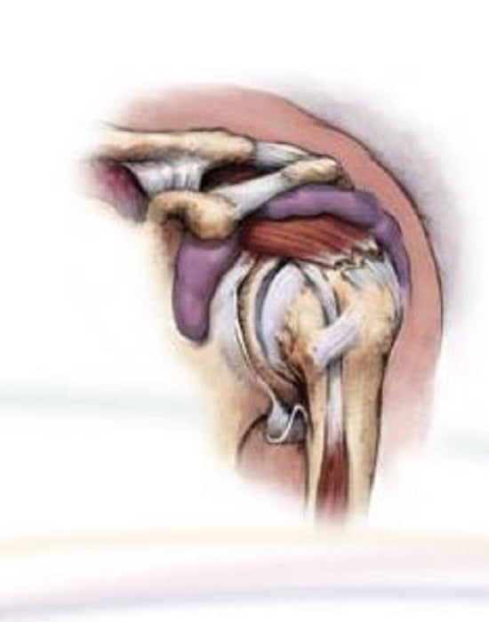 Zimmer Biomet Rotator Cuff Repair Titanium Suture Anch ALLthread Tit