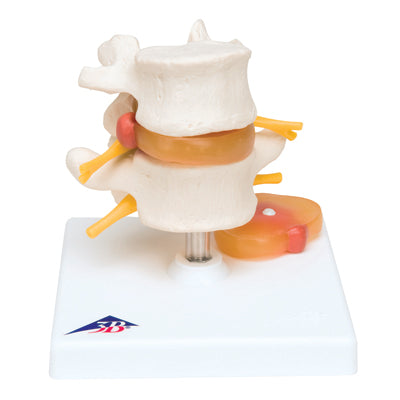 Lumbar Spinal Column with Prolapsed Intervertebral Disc
