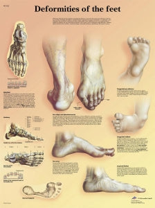 Fabrication Enterprises Inc Laminated Anatomical Charts - CHART, ANATMICAL, FOOT DEFORMITY, LAMINATED - 12-4601L