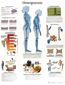 Fabrication Enterprises Inc Laminated Anatomical Charts - CHART, ANATOMICAL, OSTEOPOROSIS, LAMINATED - 12-4615L