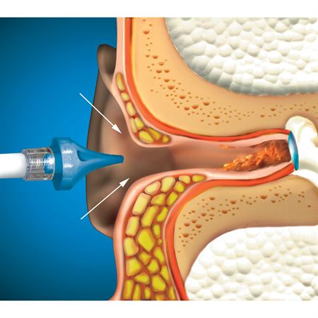 Trick of the Trade: Ear Irrigation in the Emergency Department