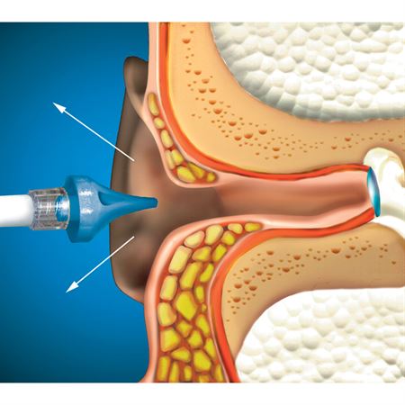 OtoClear Ear Irrigation Tip and Systems OtoClear Ear Lavage System