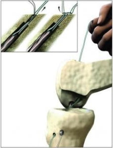 Smith & Nephew Endobutton CL Ultra - Endobutton CL Ultra Fixation Butt ...