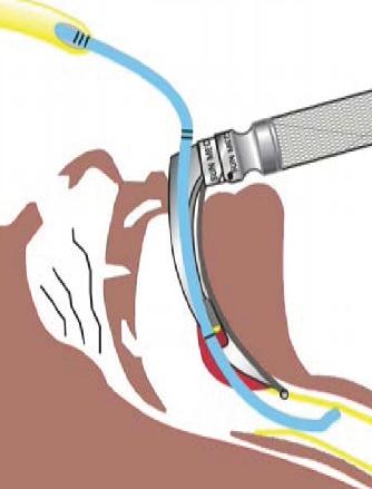 Adult Ported Introducers by SunMed