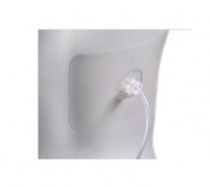 Uresil Tru-Fix Catheter Fixation System - Catheter Fixation Kit, 10 Fr - TFK-10