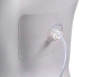 Uresil Tru-Fix Catheter Fixation System - Tru-Fix Device with Clamp and Dressing, 12 Fr - TFK-12