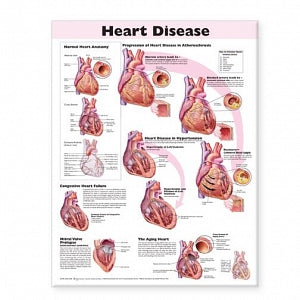 Wolters Kluwer Heart Disease Anatomical Chart - Heart Disease Anatomical Chart, English, Laminated - 9780781773386