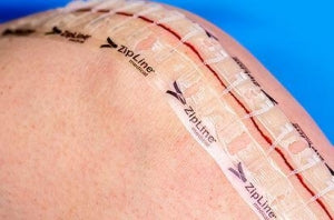 Zipline Medical Zip Surgical Skin Closures - Zip Surgical Skin Closure, 16 cm - PS1160 Zipline Medical Zip Surgical Skin Closures - Zip Surgical Skin Closure, 16 cm - PS1160